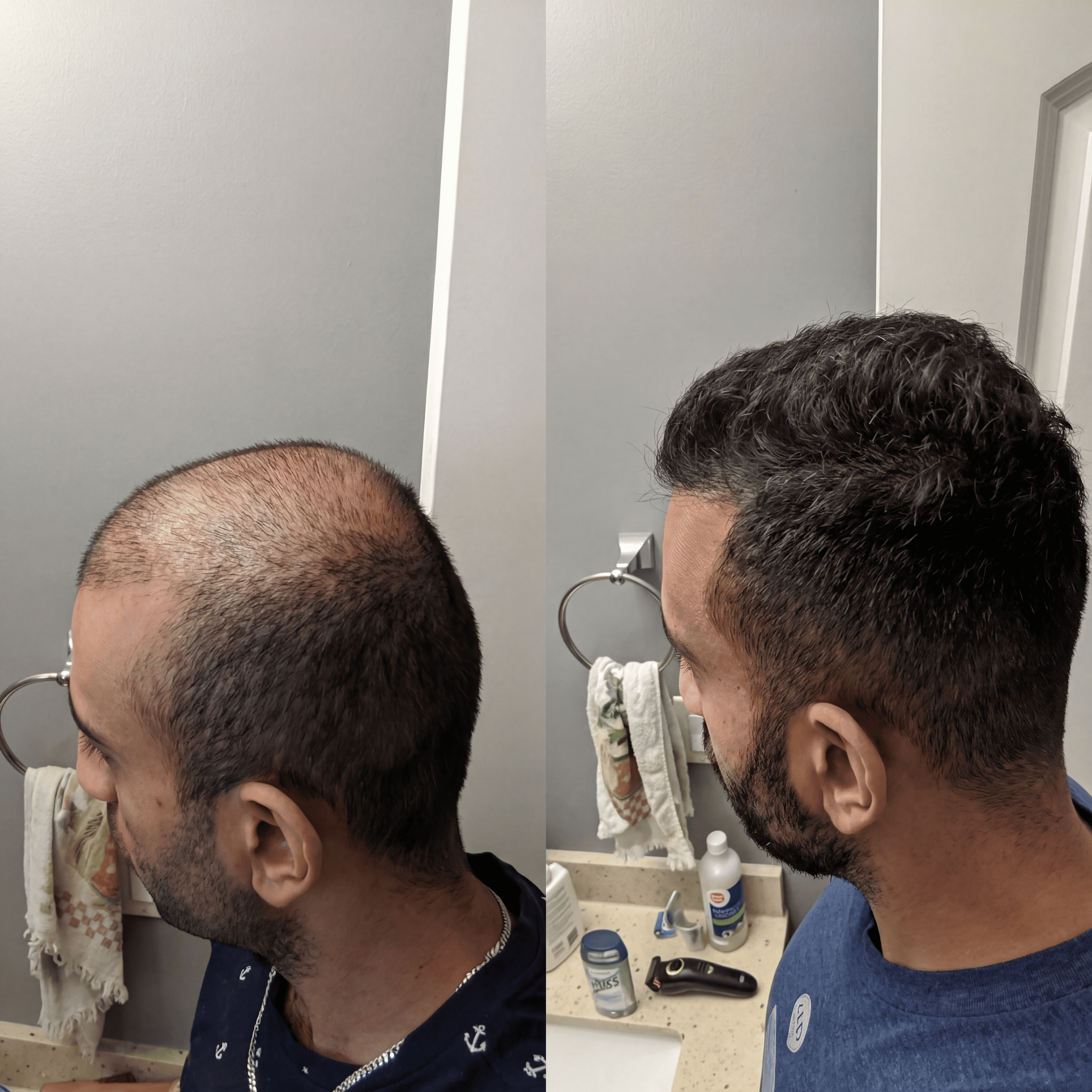 Kit micro-infusion capillaire