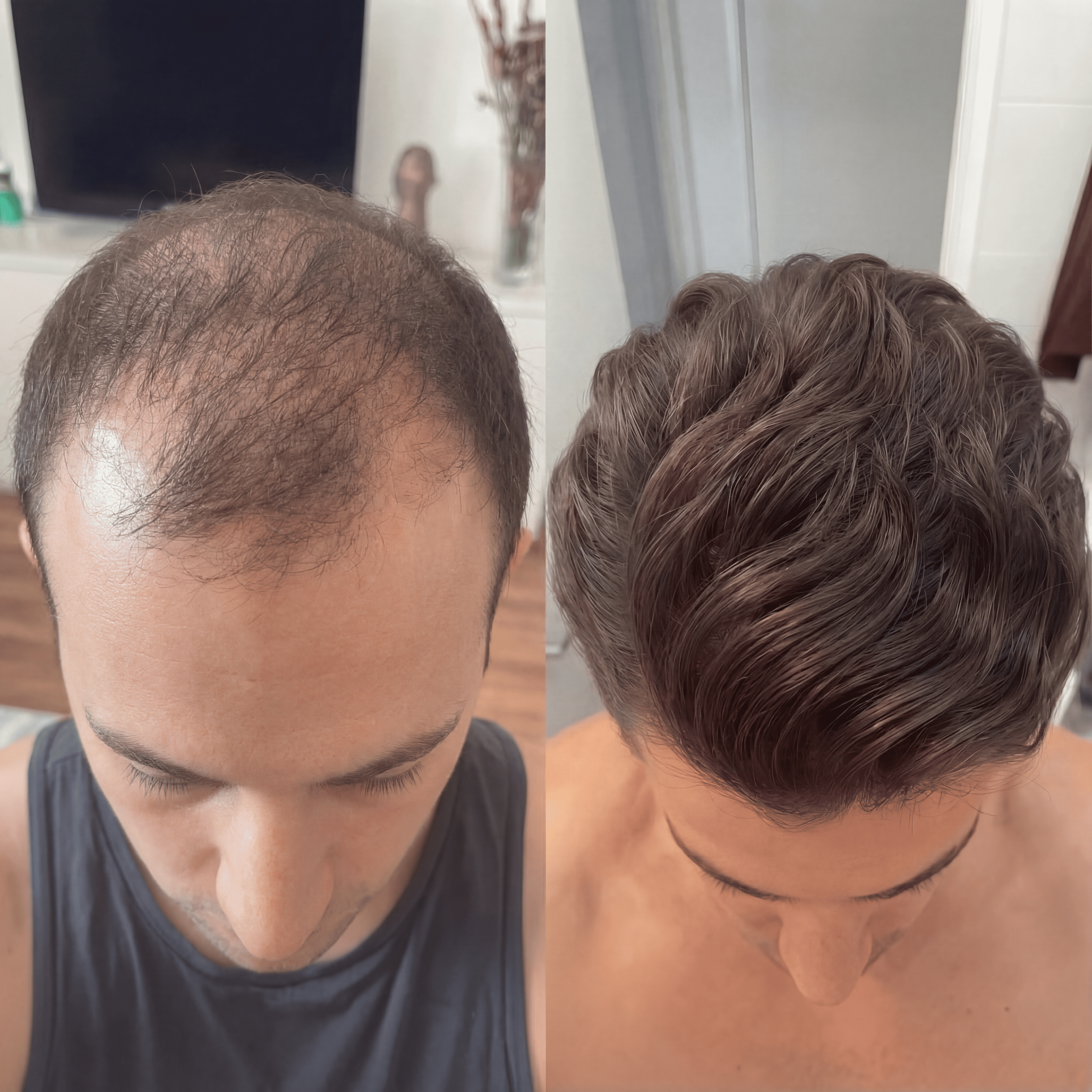 Kit micro-infusion capillaire